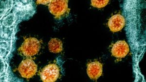 Pandemie: 613 Tage lang Corona: Seltener Infektionsfall vorgestellt